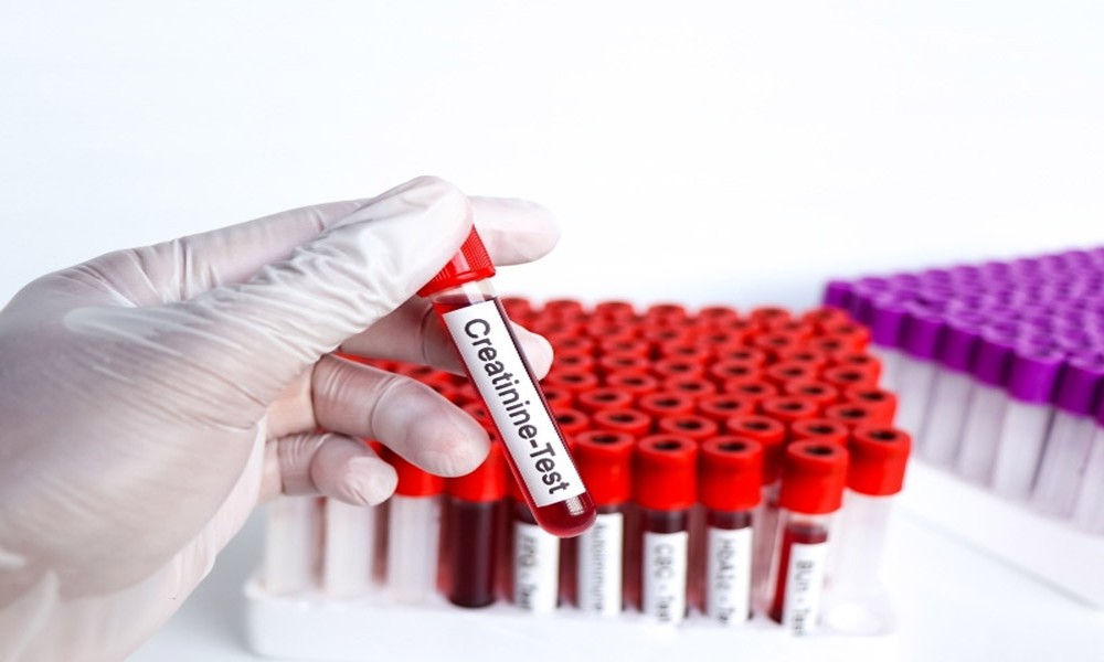 Creatinine Test: A Simple Check for Kidney Health