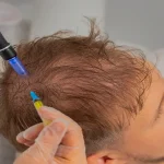 What Role Do Exosomes Play in Hair Regrowth Therapy?
